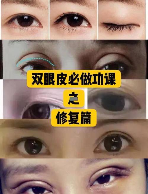 韩国双眼皮修复多少钱？从性价比角度看