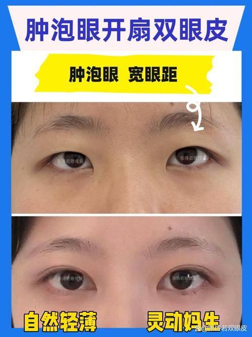 韩国双眼皮修复多少钱？痛感与体验如何