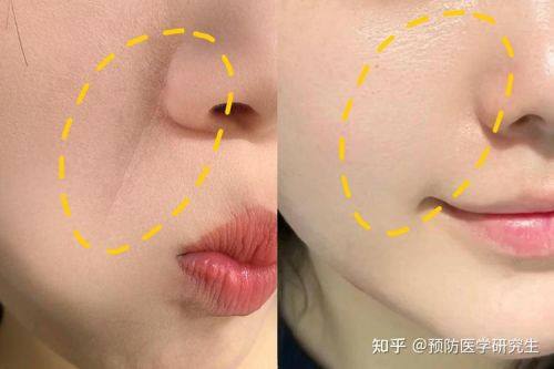 法令纹用什么玻尿酸填充好？专业解析乔雅登、瑞兰、伊婉等不同品牌玻尿酸对法令纹填充的效果差异！ 