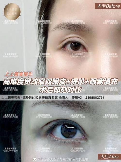 常規情況下的忌口時間