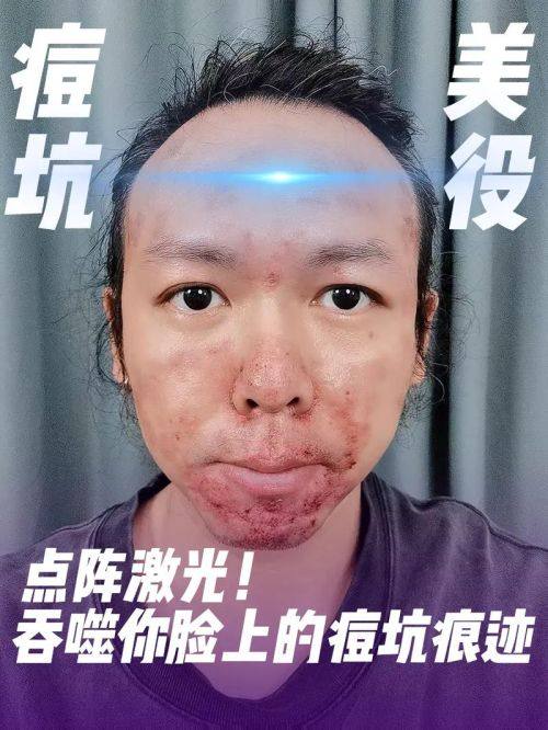 黃金微針和點陣激光哪個好?再看作用層次