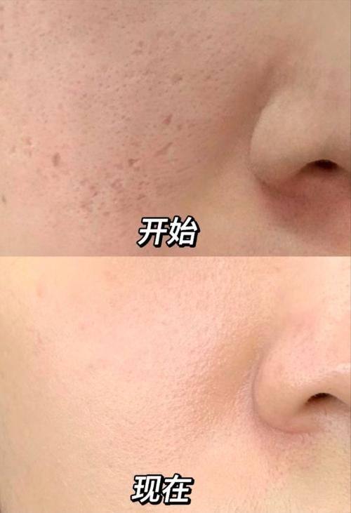 黃金微針和點陣激光哪個好?先看技術原理