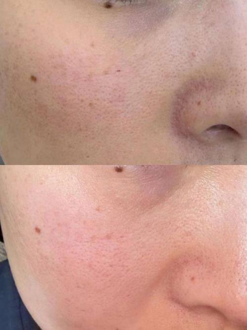 黃金微針和點陣激光哪個好?功效大比拼