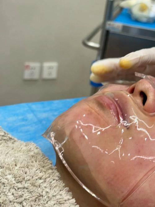 黃金微針和點陣激光哪個好?痛感、性價比和口碑分析