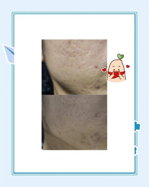 黃金微針和點陣激光哪個好?維持時間見真章