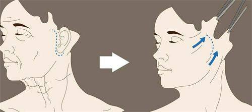 瑞蘭玻尿酸不同型號適合打哪個部位——功效及適用部位