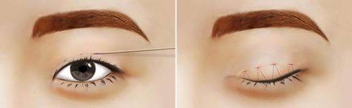 纳米双眼皮术后注意事项