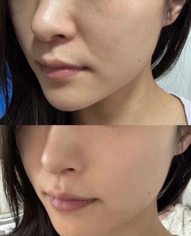 激光緊膚療程:非侵入式抗老首選