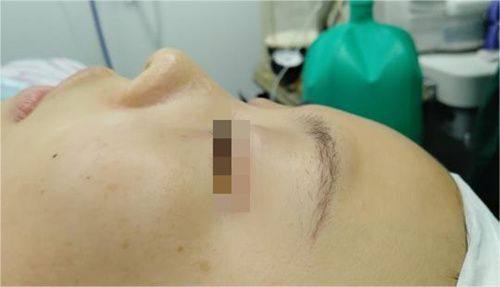 made u皮肤科美版超声刀和韩版超声刀的区别在哪？效果、价格差异一文揭秘！ 