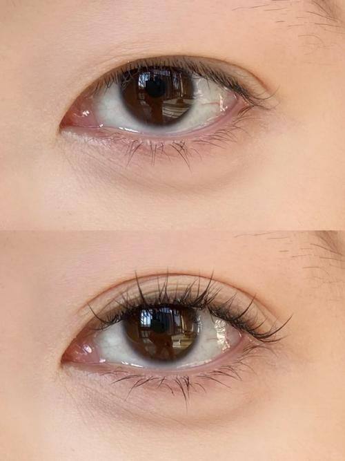 手術操作手法差異:各有千秋的技術路線