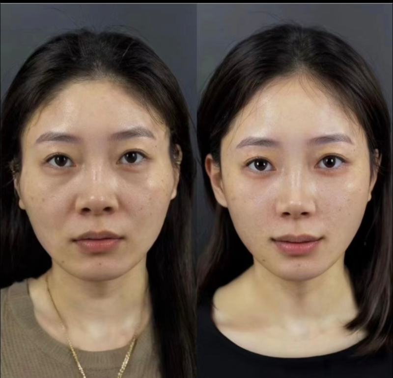 玻尿酸的潛在風險