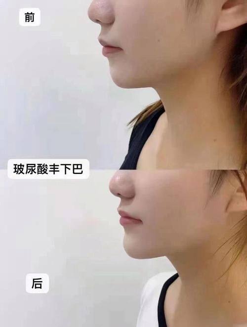 玻尿酸注射優質醫院:自然美麗的秘密武器