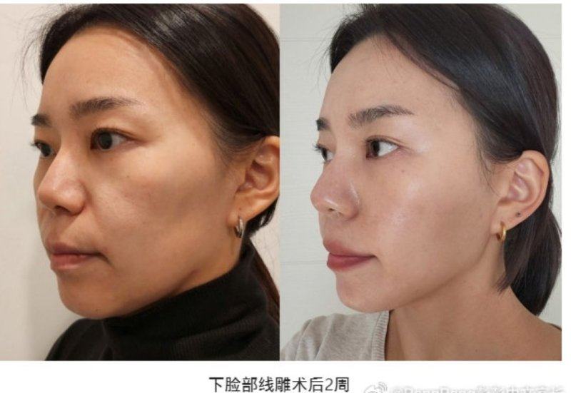 其他受推薦的韓國輪廓整形醫院