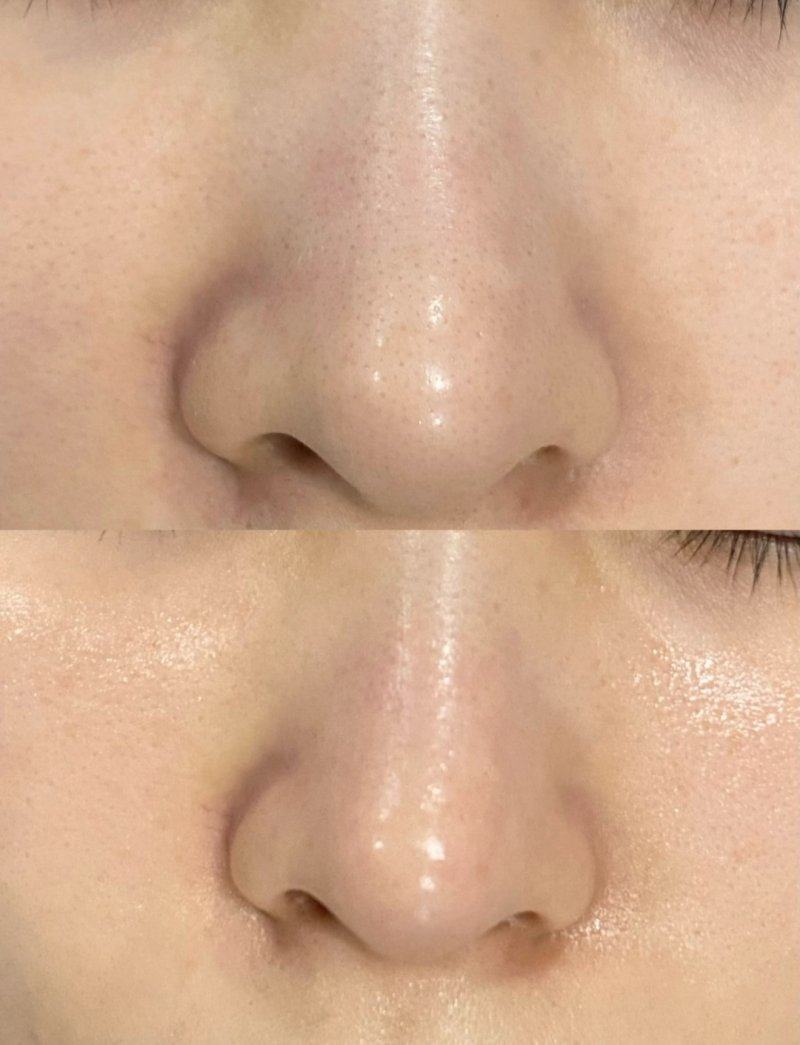 填充塑形類項目：塑造立體五官