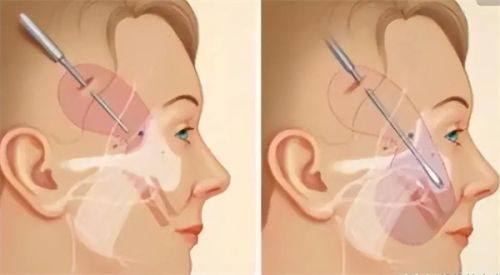 希里芙皮肤科针剂塑形套餐：项目大揭秘