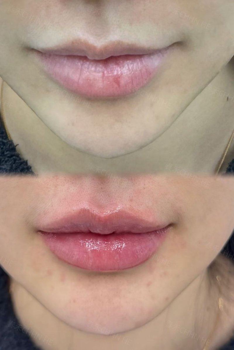 希里芙皮肤科针剂塑形套餐的成效总结