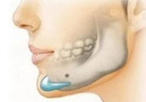 如何辨别玻尿酸圣手